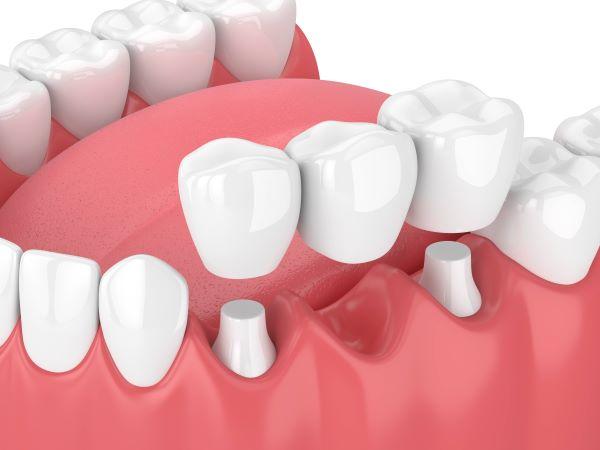 dental bridge in mouth | dental bridges white hill
