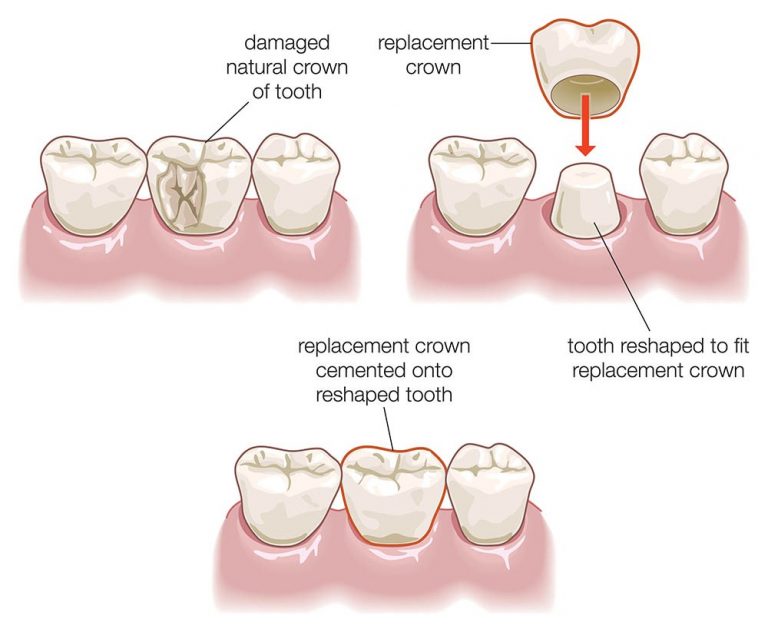 dental-crowns-treatment-by-qualified-dentist-serving-whitehills-bendigo